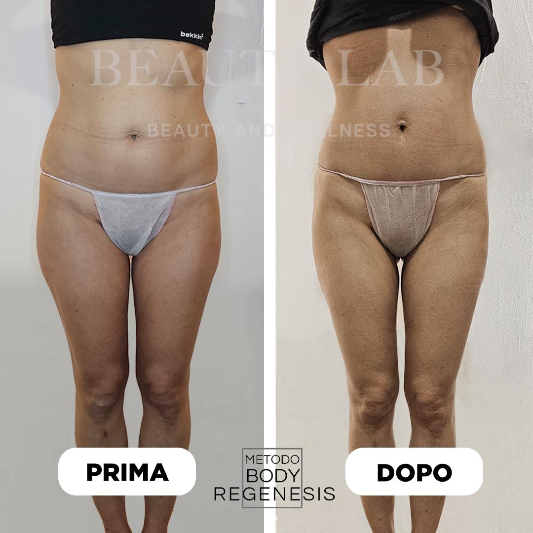 Prima e dopo Body Regenesis a Pescara: addome e cosce, silhouette definita