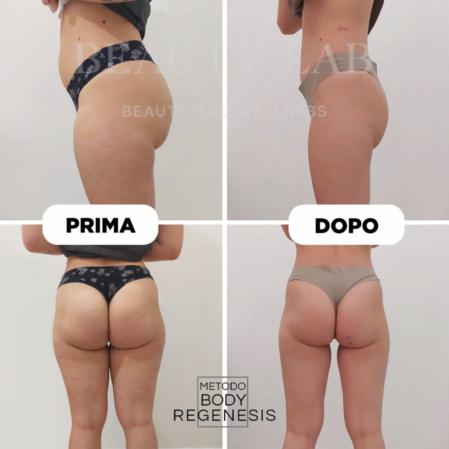 Prima e dopo Body Regenesis a Pescara: glutei, fianchi e compattezza della pelle