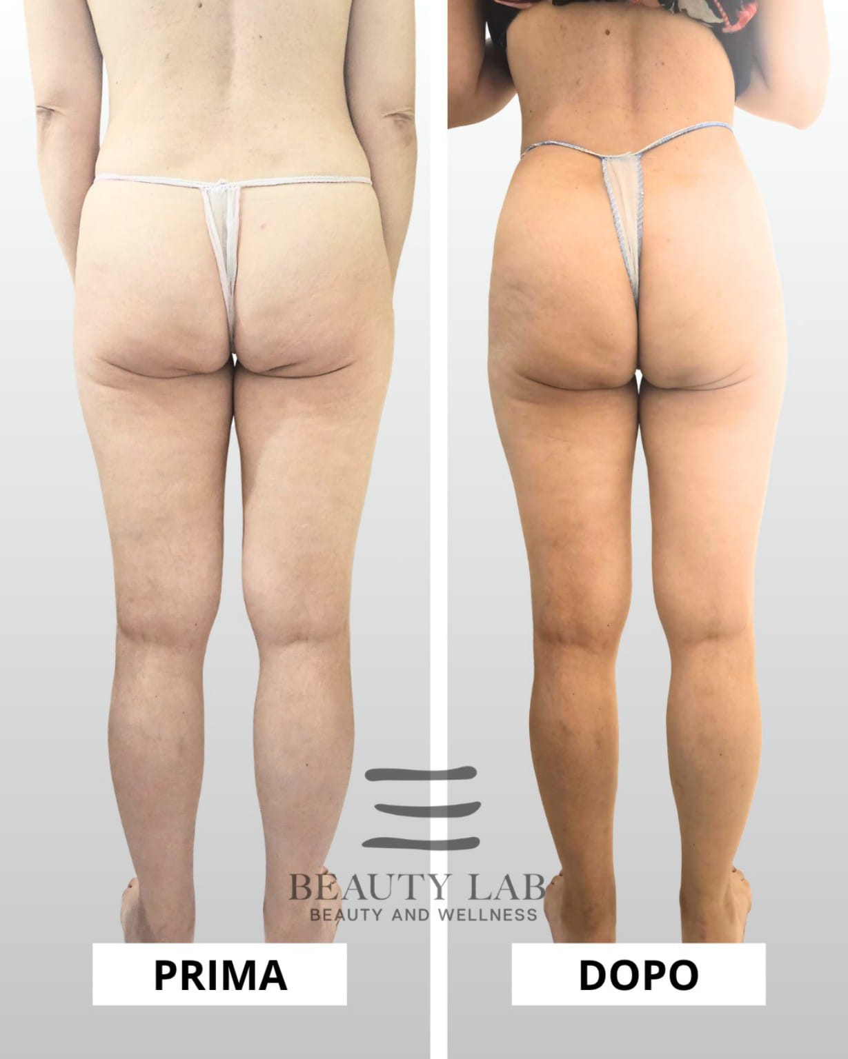 Prima e dopo Body Regenesis a Pescara: gambe e glutei più tonici
