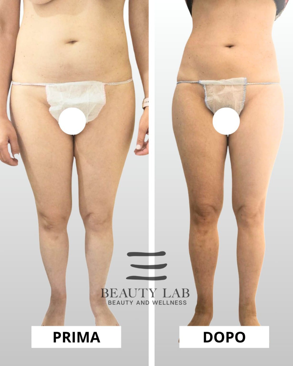 Prima e dopo Body Regenesis a Pescara: rimodellamento cosce e cellulite