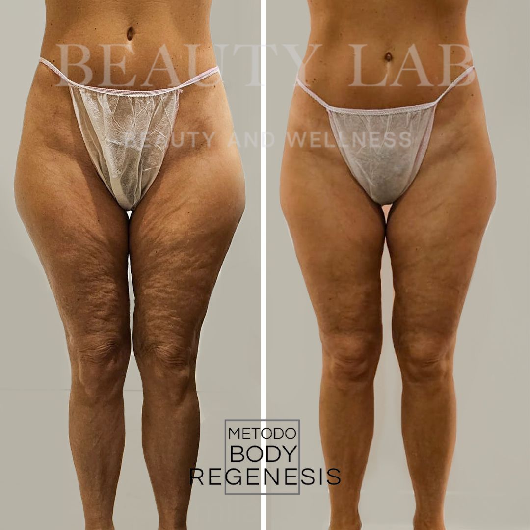 Prima e dopo Body Regenesis a Pescara: cellulite ridotta e texture pelle migliorata