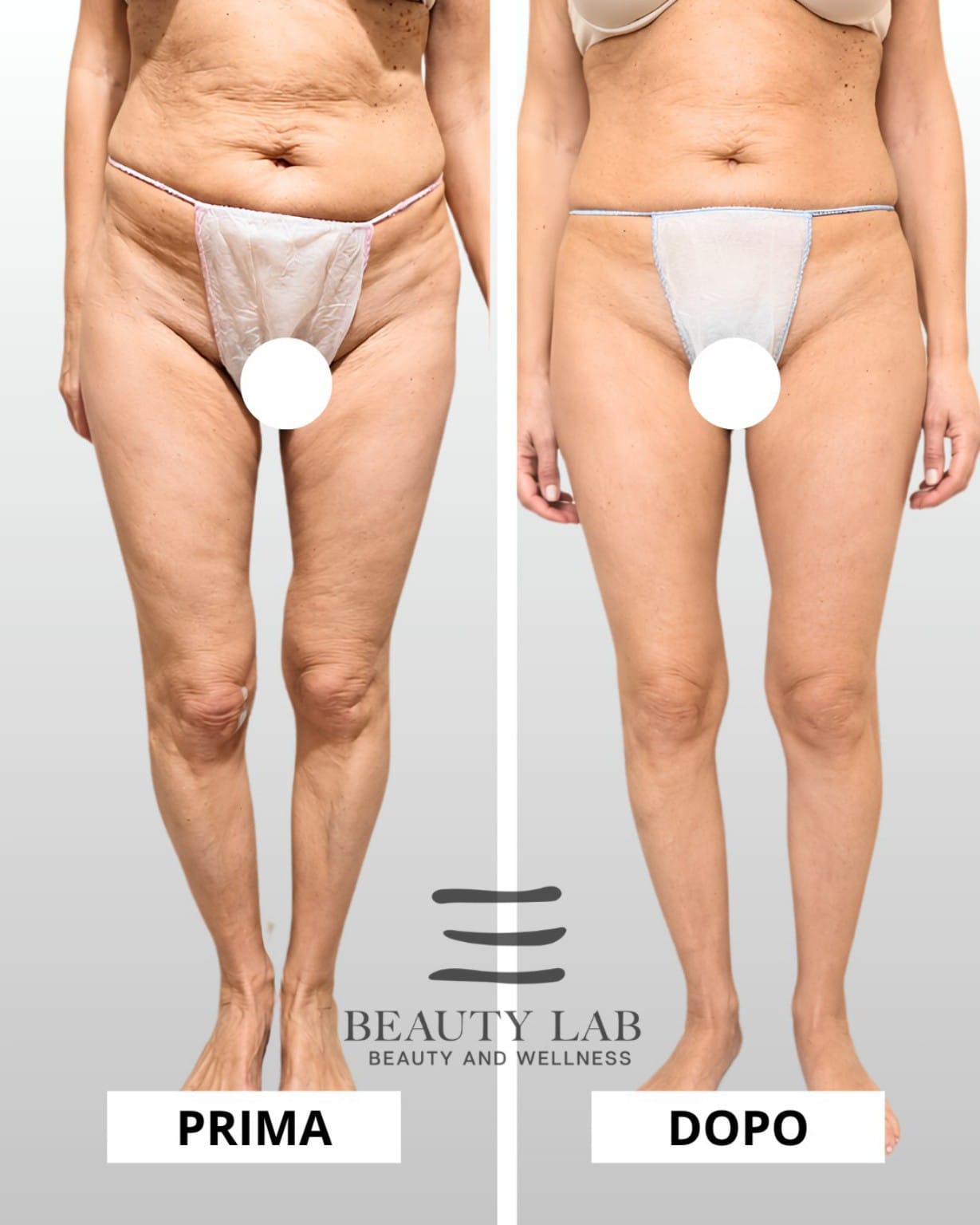 Prima e dopo Body Regenesis a Pescara: addome, fianchi e gambe rimodellate