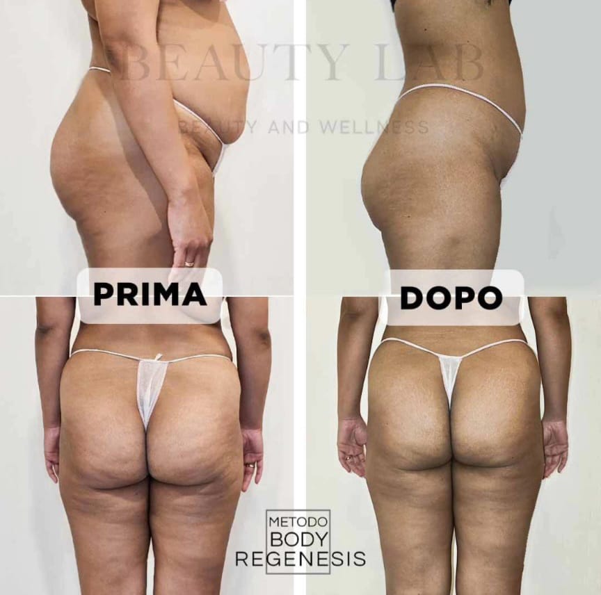 Prima e dopo Body Regenesis a Pescara: glutei e silhouette laterale rimodellati